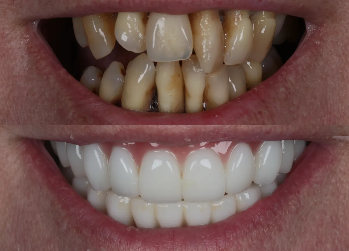Dental implant result