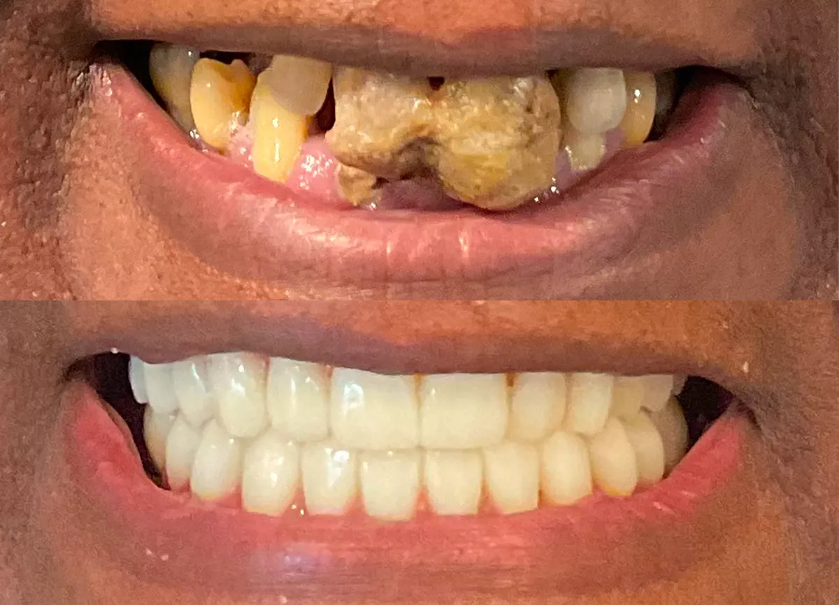 Dental implant result