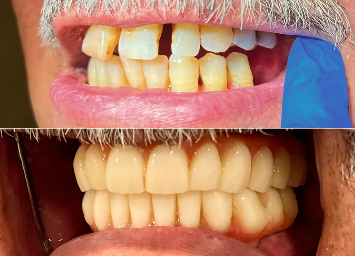 Dental implant result