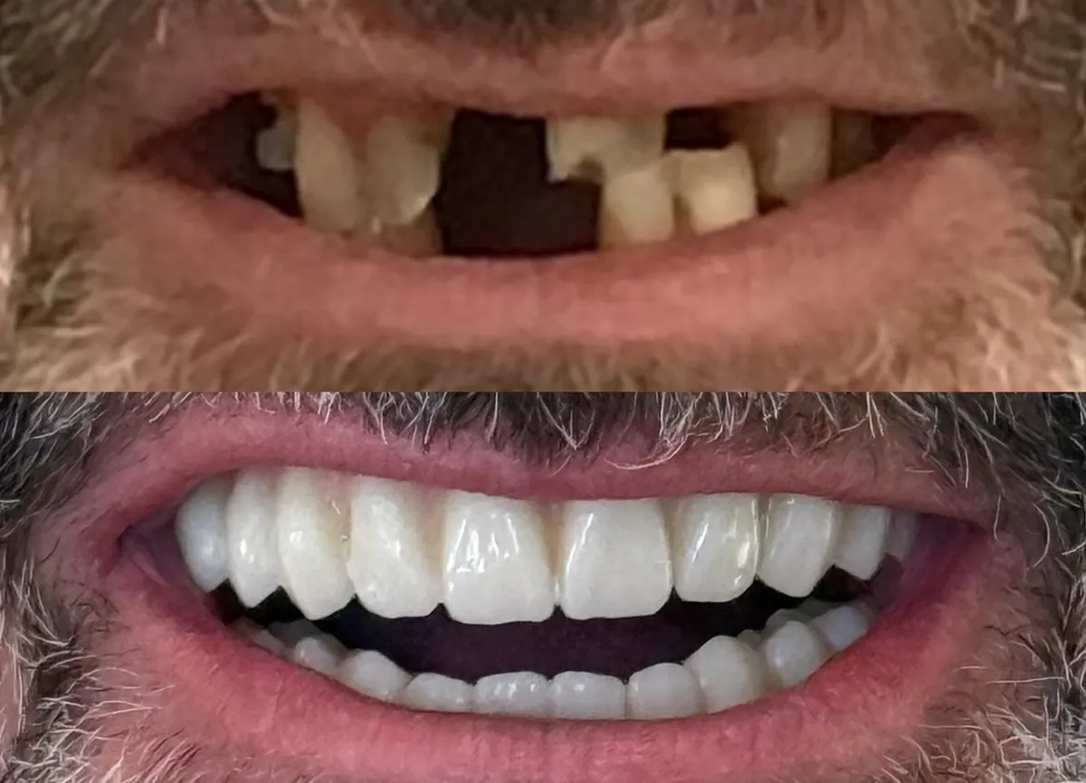 Dental implant result