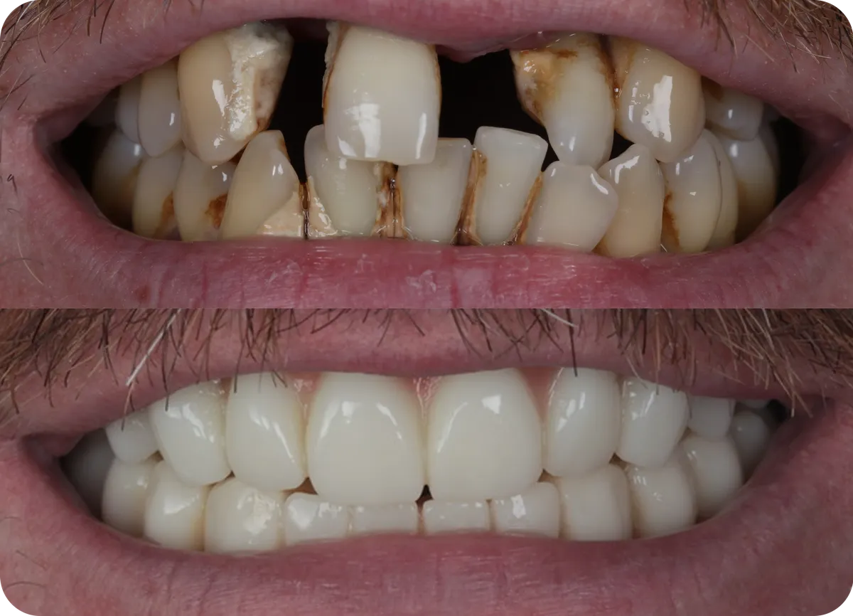 Dental implant result