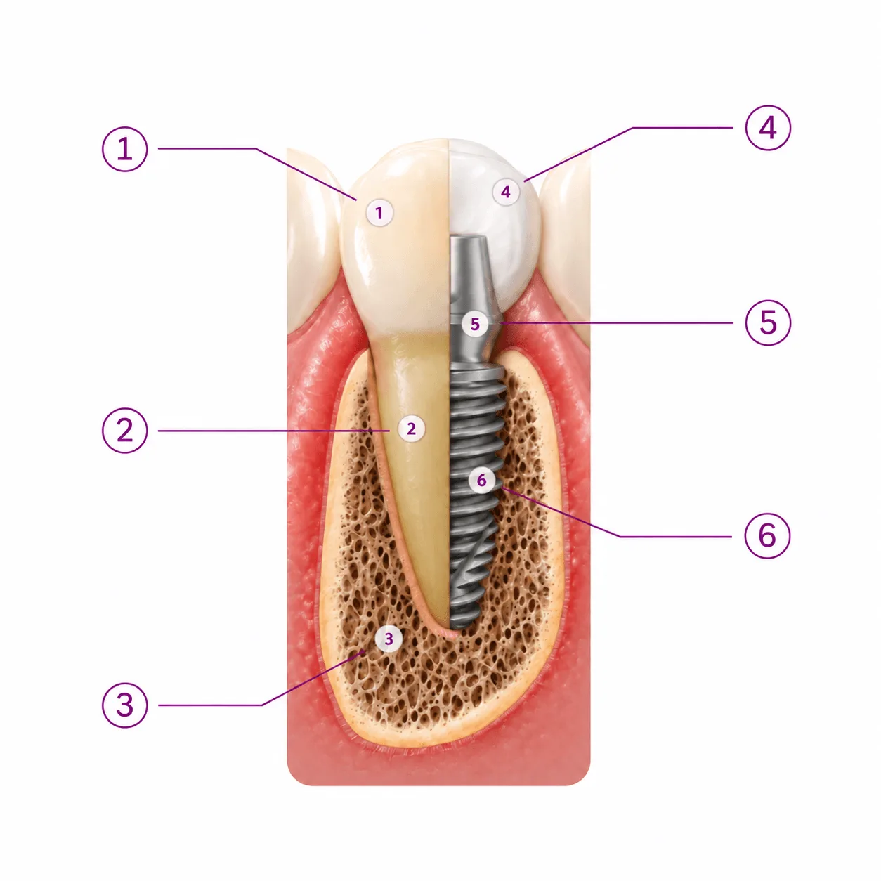 Cross-section through the jaw: a natural tooth on the left and a dental implant on the right, with six parts numbered.